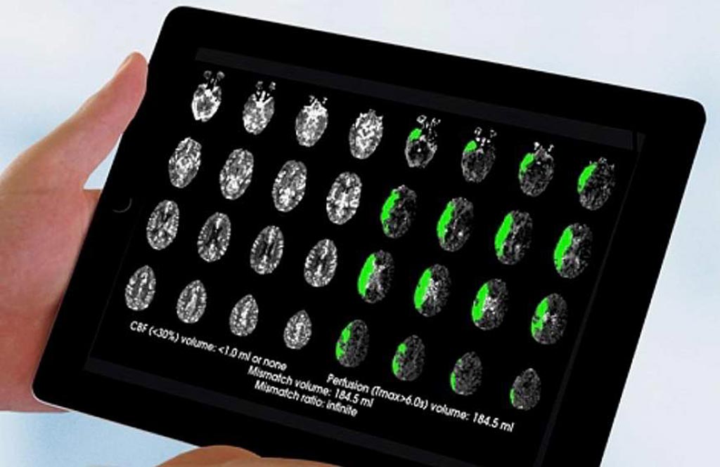 Imagen: Un estudio sugiere que la tecnología de imágenes de perfusión puede identificar a más pacientes elegibles para el tratamiento del accidente cerebrovascular (Fotografía cortesía de Greg Albers/Universidad de Stanford). Imagen: Un estudio sugiere que la tecnología de imágenes de perfusión puede identificar a más pacientes elegibles para el tratamiento del accidente cerebrovascular (Fotografía cortesía de Greg Albers/Universidad de Stanford).