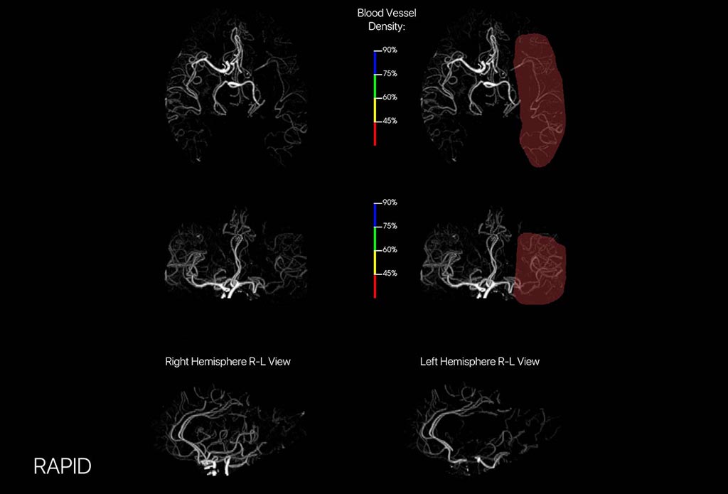 Imagen: Una plataforma avanzada de imágenes cerebrales proporciona una imagen óptima de la CTA (Fotografía cortesía de iSchemaView). Imagen: Una plataforma avanzada de imágenes cerebrales proporciona una imagen óptima de la CTA (Fotografía cortesía de iSchemaView).