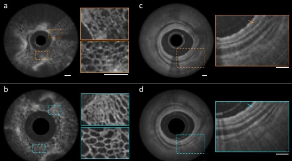 Imágenes de pulpa de fruta (I) y de vías respiratorias de cerdo (D) obtenidas con el endoscopio nano-óptico (b, d) y un catéter convencional (a, c) (Fotografía cortesía de la Universidad de Harvard/MGH). Imágenes de pulpa de fruta (I) y de vías respiratorias de cerdo (D) obtenidas con el endoscopio nano-óptico (b, d) y un catéter convencional (a, c) (Fotografía cortesía de la Universidad de Harvard/MGH).