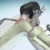 Imagen: Un sistema de RTR novedoso guiado por robot usa guías para dirigir con precisión la resección ósea (Fotografía cortesía de OMNI).