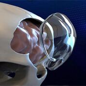 Imagen: Un implante transparente de PMMA reconstruye el cráneo después de una craneotomía (Fotografía cortesía de Longeviti).