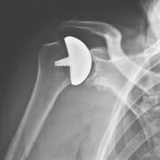 Imagen: Imagen de rayos X del sistema de implantes OVOMotion sin vástago (Fotografía cortesía de Arthrosurface).