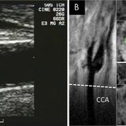 Imagen: Ecografías (A) y resonancias magnéticas (B) de la arteria carótida común (Fotografía cortesía de Bruce Wasserman/JHU). Imagen: Ecografías (A) y resonancias magnéticas (B) de la arteria carótida común (Fotografía cortesía de Bruce Wasserman/JHU).