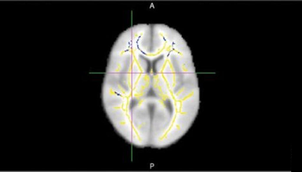 Imagen: La DTI-MRI que muestra áreas de anisotropía fraccional reducida indicando daño cerebral en la materia blanca (Fotografía cortesía de Cyrus Raji / RSNA). Imagen: La DTI-MRI que muestra áreas de anisotropía fraccional reducida indicando daño cerebral en la materia blanca (Fotografía cortesía de Cyrus Raji / RSNA).