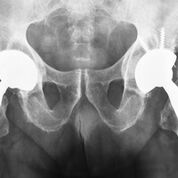 Imagen: El estudio de prótesis de implante de cadera (HIPS, por sus siglas en inglés) ha demostrado que a mayor edad del paciente, es más probable que los reemplazos de cadera de metal sobre plástico cementados sean más rentables (Fotografía cortesía de ODT).