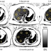 Imagen: Mapas de la PDFF en una mujer de 55 años a quien le practicaron un bypass gástrico que demuestra una reducción progresiva de la grasa hepática (Fotografía cortesía de la RSNA).