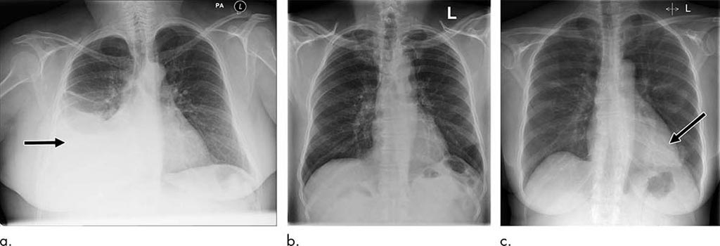 Imagen: Ejemplos de radiografías con prioridad correcta e incorrecta. (a) La radiografía fue informada mostrando un derrame pleural derecho grande (flecha). Esto fue correctamente priorizado como urgente. (b) Se notificó que la radiografía muestra “lucencia en el vértice izquierdo sospechoso de neumotórax”. Esto se priorizó como normal. En revisión por tres radiólogos independientes, la radiografía se consideró unánimemente normal. (c) Una radiografía se informó mostrando una consolidación proyectada detrás del corazón (flecha). El sistema de inteligencia artificial pasó por alto el hallazgo y el estudio se priorizó incorrectamente como normal (Fotografía cortesía de la RSNA).