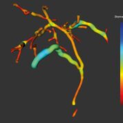 Imagen: Imágenes de MRCP+ del árbol biliar (Fotografía cortesía de Perspectum Diagnostics).