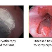 Imagen: El nitrógeno líquido puede congelar instantáneamente el tejido esofágico enfermo (Fotografía cortesía de CSA Medical).