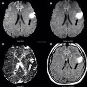 Imagen: Como parte de un estudio nuevo, los investigadores encontraron que, para los pacientes con accidente cerebrovascular tratados con tPA por vía intravenosa entre 3 y 6 horas después de la aparición, los hallazgos iniciales de la resonancia magnética pueden identificar subgrupos que probablemente se beneficien de las terapias de reperfusión y pueden identificar subgrupos que probablemente no se beneficien o se puedan ver perjudicados (Fotografía cortesía de Medscape).
