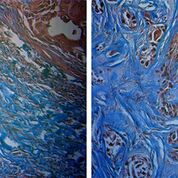 Imagen: Tumor sensible a la radiación (I), y tumor resistente a la radiación (D). Los tumores sensibles tienen más colágeno (azul) (Fotografía cortesía de la Universidad de Arkansas). Imagen: Tumor sensible a la radiación (I), y tumor resistente a la radiación (D). Los tumores sensibles tienen más colágeno (azul) (Fotografía cortesía de la Universidad de Arkansas).