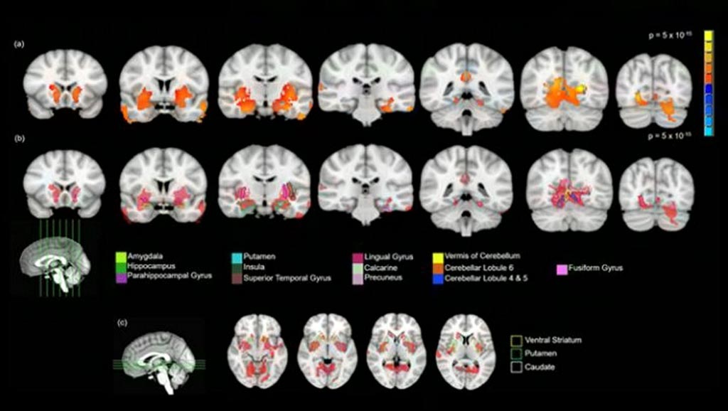 Imágenes: Regiones que muestran mayor VMG en los jóvenes de 14 años que fumaron cannabis (Fotografía cortesía de la revista Journal of Neuroscience). Imágenes: Regiones que muestran mayor VMG en los jóvenes de 14 años que fumaron cannabis (Fotografía cortesía de la revista Journal of Neuroscience).