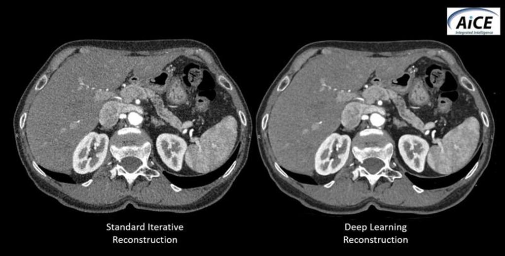 Imagen: Una comparación entre las imágenes de TC reconstruidas utilizando el software de reconstrucción iterativo estándar y la solución AiCE de Canon (Fotografía cortesía de Canon Medical).