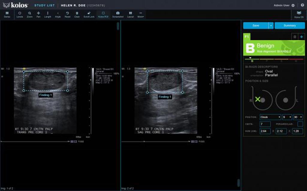 Imagen: Una captura de pantalla del software Koios DS Breast 2.0 basado en la IA (Fotografía cortesía de Koios Medical). Imagen: Una captura de pantalla del software Koios DS Breast 2.0 basado en la IA (Fotografía cortesía de Koios Medical).