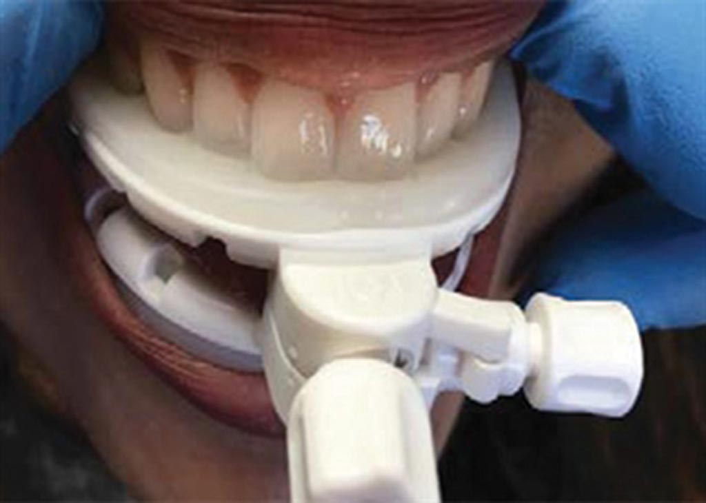 Imagen: El stent dental con desplazamiento de la lengua, GrayDuck (Fotografía cortesía de CIVCO Radiotherapy). Imagen: El stent dental con desplazamiento de la lengua, GrayDuck (Fotografía cortesía de CIVCO Radiotherapy).