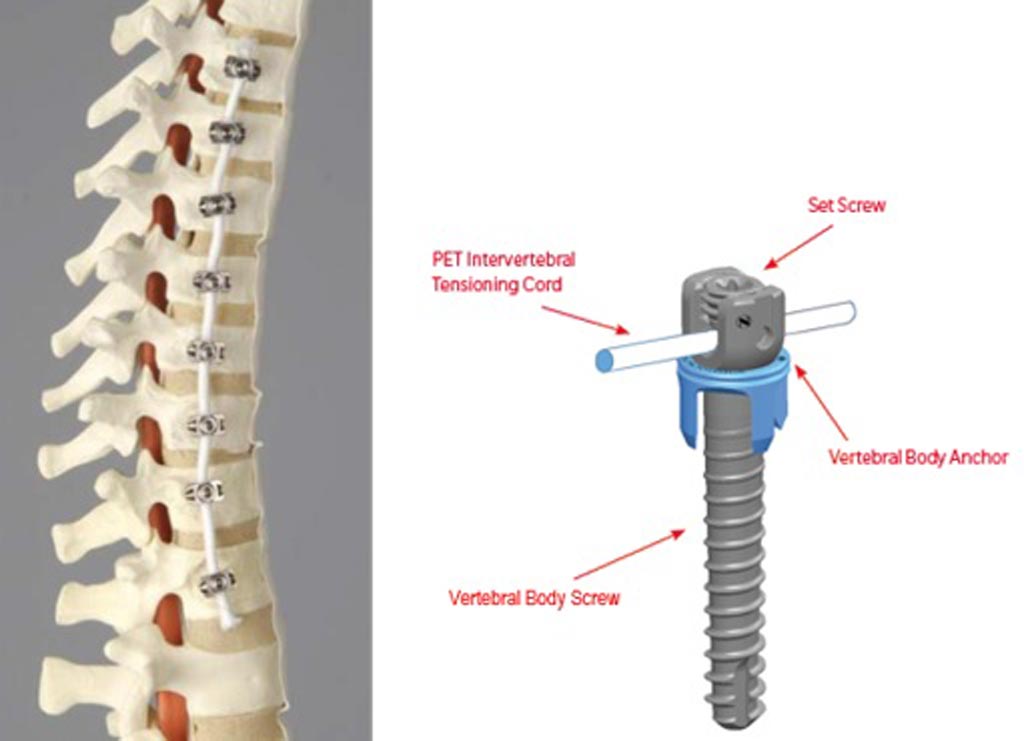 Imagen: el dispositivo Tether demuestra que atar la médula espinal puede corregir la escoliosis (Fotografía cortesía de la FDA).