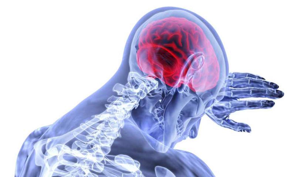 Imagen: El algoritmo de aprendizaje automático, llamado DeepSymNet, aprendió a identificar los bloqueos de los vasos sanguíneos posteriores al accidente cerebrovascular a partir de imágenes de angiografía por TC (Fotografía cortesía de Medical Xpress). Imagen: El algoritmo de aprendizaje automático, llamado DeepSymNet, aprendió a identificar los bloqueos de los vasos sanguíneos posteriores al accidente cerebrovascular a partir de imágenes de angiografía por TC (Fotografía cortesía de Medical Xpress).