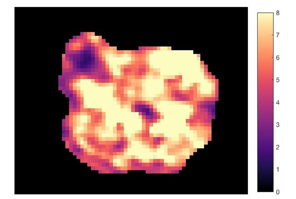 Imagen: Un mapa de la elasticidad del tumor que muestra la rigidez marcada de un tumor pancreático (Fotografía cortesía de Yann Jamin/ ICR). Imagen: Un mapa de la elasticidad del tumor que muestra la rigidez marcada de un tumor pancreático (Fotografía cortesía de Yann Jamin/ ICR).