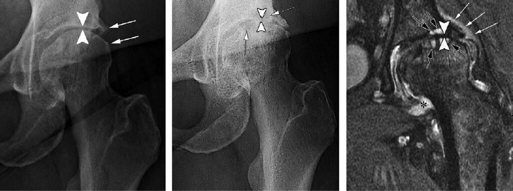 Imagen: Pérdida progresiva de cartílago acetabular y femoral y cambios quísticos subcondrales después de la IACS (Fotografía cortesía de Ali Guermazi Radiology).