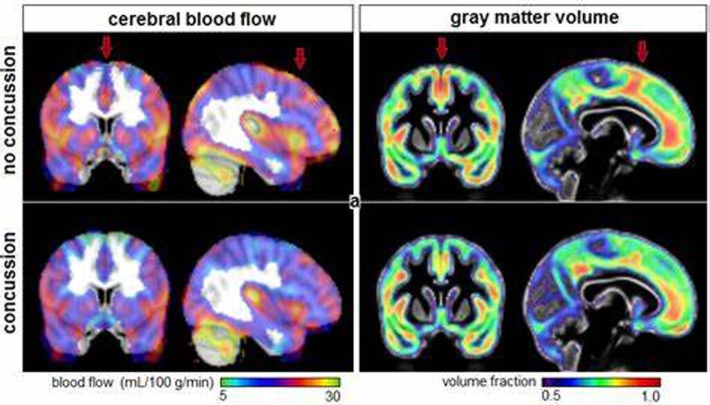 Imagen: La CBF (I) y la fracción de volumen de la materia gris (D) para los atletas con y sin historia de conmoción cerebral (Fotografía cortesía de Nathan Churchill/ Hospital St. Michael\'s). Imagen: La CBF (I) y la fracción de volumen de la materia gris (D) para los atletas con y sin historia de conmoción cerebral (Fotografía cortesía de Nathan Churchill/ Hospital St. Michael\'s).