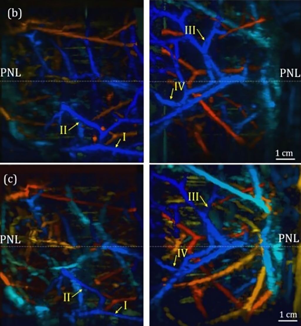 Imagen: Tejido mamario adquirido por el DSM, con los vasos en azul más cercanos a la superficie mamaria (Fotografía cortesía de Jun Xia, Universidad de Buffalo) Imagen: Tejido mamario adquirido por el DSM, con los vasos en azul más cercanos a la superficie mamaria (Fotografía cortesía de Jun Xia, Universidad de Buffalo)