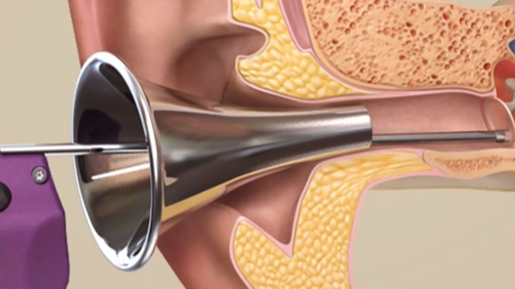 Imagen: Un sistema nuevo de administración coloca los tubos auditivos sin dolor (Fotografía cortesía de Tusker Medical)