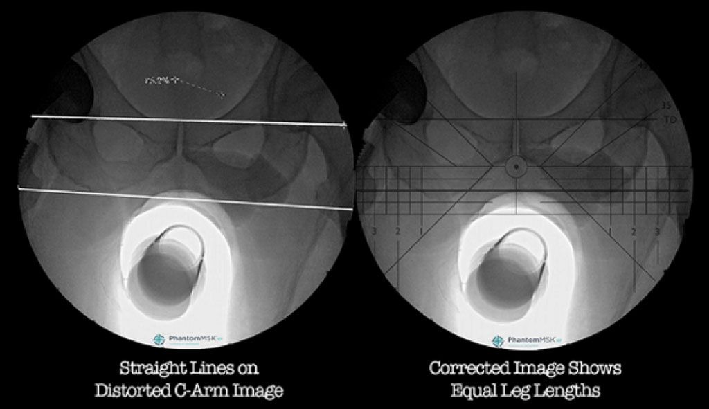 Imagen: Fluoroscopias de cadera distorsionadas y corregidas con PhantomMSK (Fotografía cortesía de OrthoGrid Systems)
