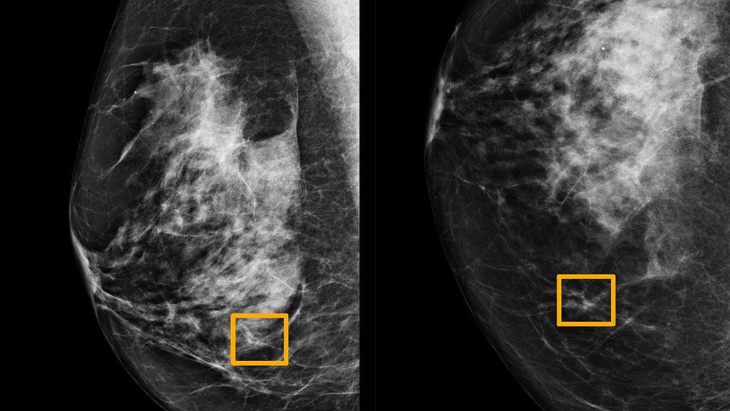 Imagen: La IA detecta el cáncer en mamografías de rutina en las que seis radiólogos no pudieron (Fotografía cortesía de la Universidad Northwestern) Imagen: La IA detecta el cáncer en mamografías de rutina en las que seis radiólogos no pudieron (Fotografía cortesía de la Universidad Northwestern)