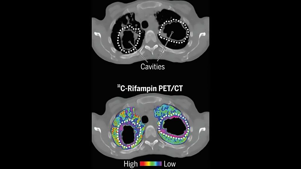 Imagen: Las imágenes dinámicas de TEP/TC con 11C-rifampicina pueden ayudar al tratamiento de la tuberculosis (Fotografía cortesía de Johns Hopkins Medicine)