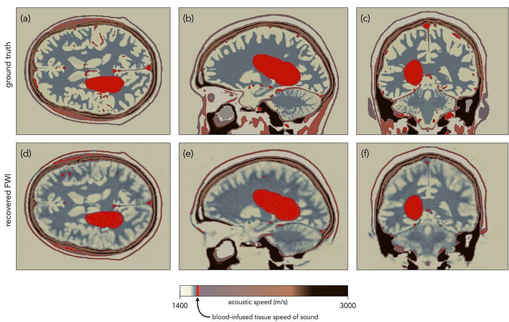 Imagen: Imágenes simuladas por computadora de la FWI detectando una hemorragia cerebral (Fotografía cortesía del Colegio Imperial de Londres) Imagen: Imágenes simuladas por computadora de la FWI detectando una hemorragia cerebral (Fotografía cortesía del Colegio Imperial de Londres)