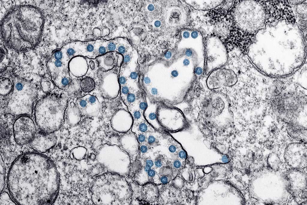 Imagen: Microfotografía electrónica de transmisión de un aislado de un caso de COVID-19, causado por el coronavirus SARS-CoV-2. Las partículas virales esféricas, de color azul, contienen cortes transversales a través del genoma viral, vistas como puntos negros (Foto cortesía de Hannah A Bullock y Azaibi Tamin). Imagen: Microfotografía electrónica de transmisión de un aislado de un caso de COVID-19, causado por el coronavirus SARS-CoV-2. Las partículas virales esféricas, de color azul, contienen cortes transversales a través del genoma viral, vistas como puntos negros (Foto cortesía de Hannah A Bullock y Azaibi Tamin).