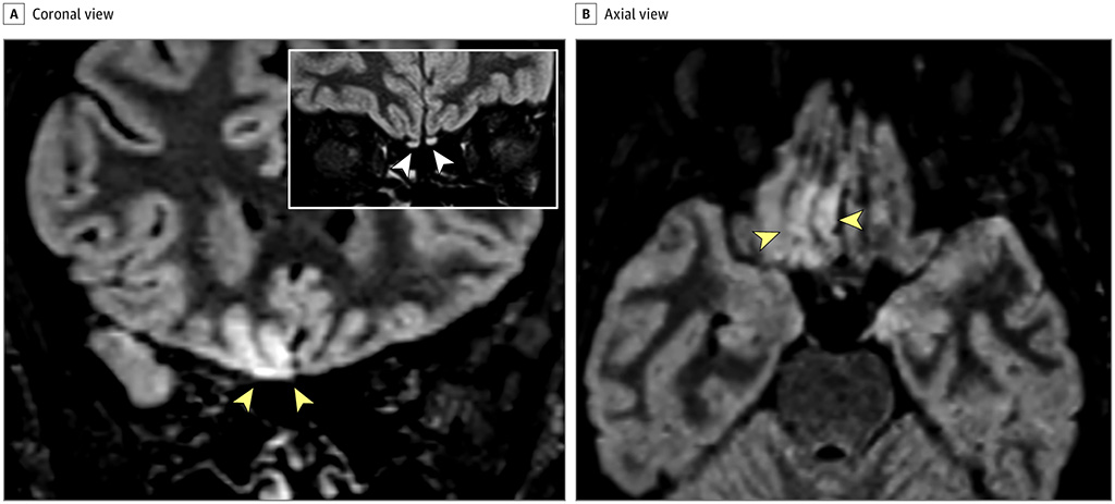 Imagen: Alteraciones en las imágenes de resonancia magnética cerebral en un paciente con enfermedad por coronavirus 2019 (Fotografía cortesía de JAMA Network)