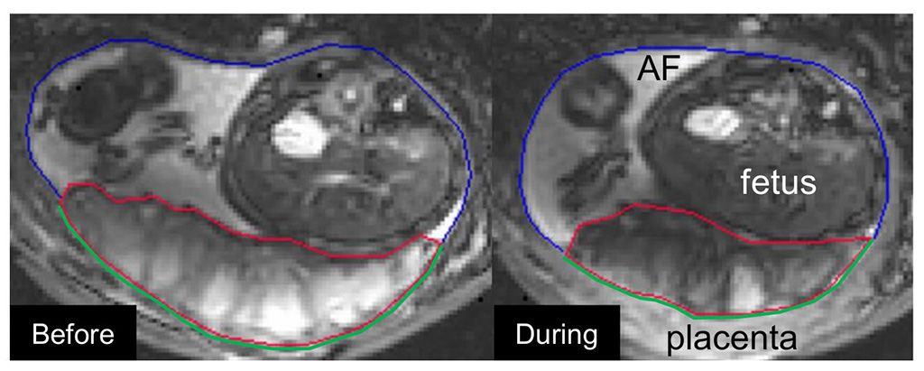 Imagen: Ejemplo de la bomba utero-placentaria; placenta relajada (I), placenta contraída (D) (Fotografía cortesía de Nelle Dellschaft/Universidad de Nottingham)
