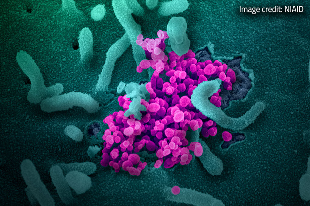 Imagen: Imágenes en tiempo real muestran cómo el SARS-CoV-2 ataca las células humanas (Fotografía cortesía de NIAID)