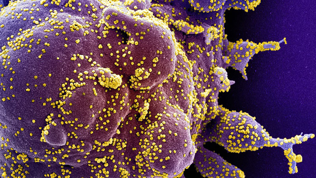 Imagen: Microfotografía electrónica de barrido coloreada de una célula (violeta) muy infectada con partículas del virus SARS-CoV-2 (amarillo) (Fotografía cortesía del Instituto Nacional de Alergias y Enfermedades Infecciosas, Institutos Nacionales de Salud)