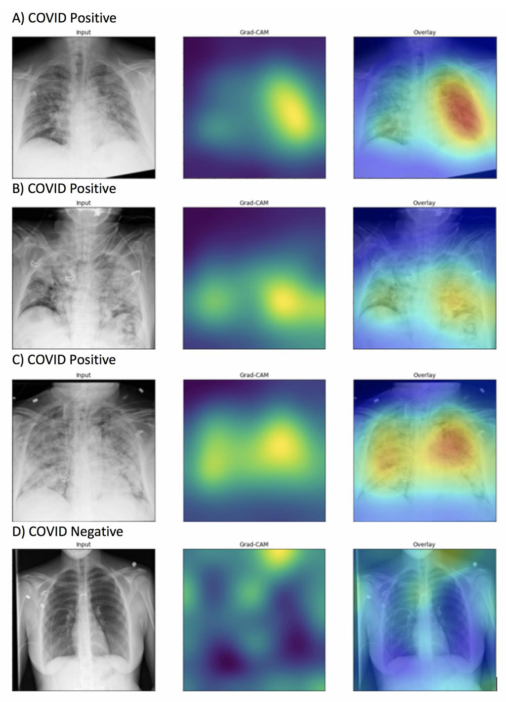Imagen: Los mapas de calor generados resaltaron adecuadamente las anomalías de los campos pulmonares en las imágenes marcadas con exactitud como positivas para COVID-19 (de la A a la C) a diferencia de las imágenes que fueron marcadas con exactitud como negativas para COVID-19 (D). La intensidad de los colores que aparecen en el mapa de calor corresponde a las características de la imagen que son significativas para predecir la positividad para COVID-19 (Fotografía cortesía de la Universidad Northwestern)