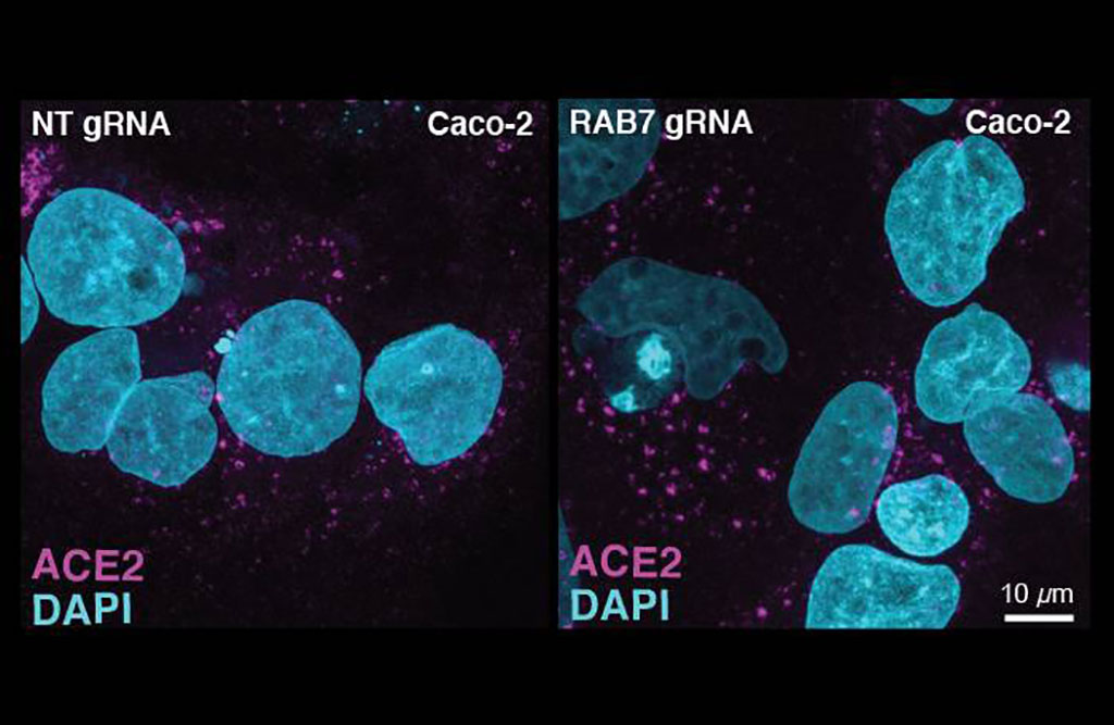 Imagen: Imágenes representativas de coloración por inmunofluorescencia de ACE2 en células Caco-2, transducidas con una guía de orientación de NT o RAB7A (Fotografía cortesía del Centro del Genoma de Nueva York)