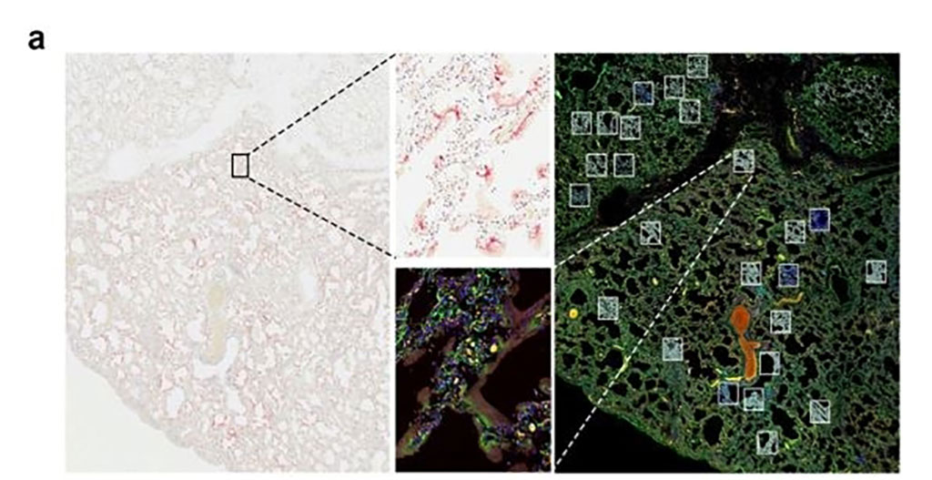 Imagen: El SARS-CoV-2 se visualiza en tejido pulmonar infectado de 6 muestras de tejido diferentes con la sonda ACD RNAscope (rosa), y se seleccionaron las ROI correspondientes, positivas y negativas al virus, de una sección en serie para la elaboración de perfiles GeoMx con el Atlas del transcriptoma del cáncer (Fotografía cortesía de Business Wire)