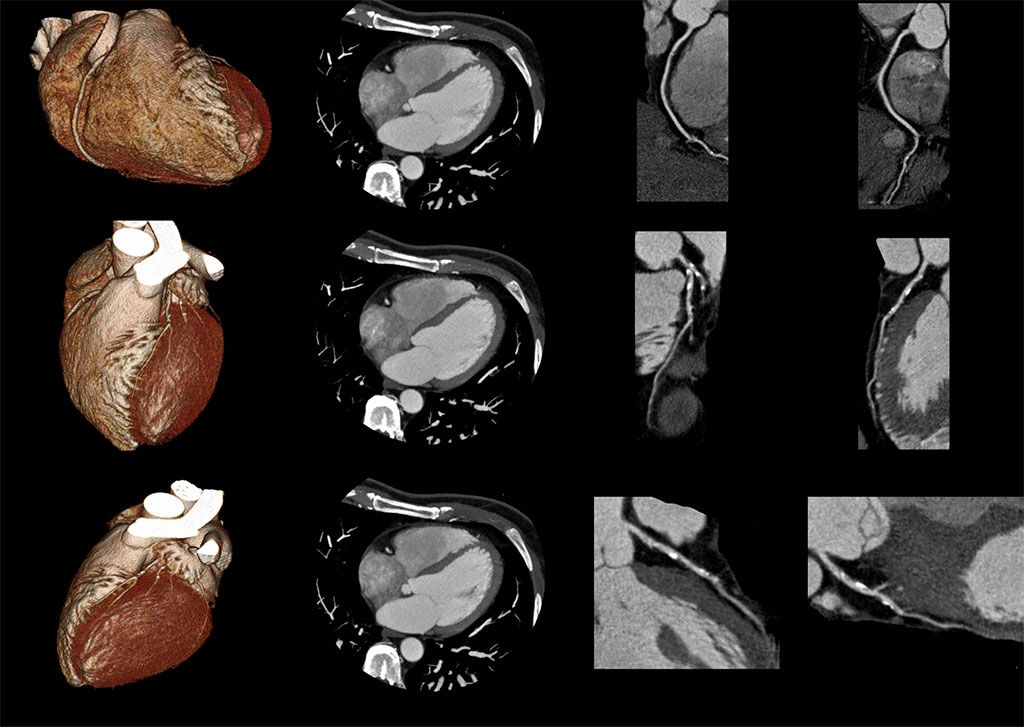 Imagen: La TC cardiaca con IA puede detectar la acumulación de calcio en la válvula aórtica (Fotografía cortesía de Getty Images)