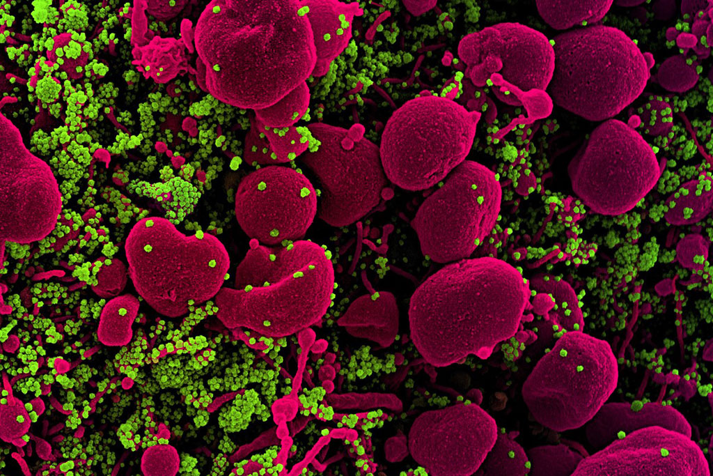 Imagen: Micrografía electrónica de barrido coloreada de una célula infectada con SARS-COV-2 (Fotografía cortesía del NIAID)