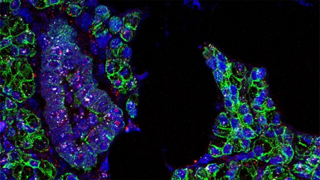 Imagen: Se encontró ARN para SARS-CoV-2 (rosa) y el receptor ACE2 (blanco) en las células de las glándulas salivales, que están delineadas en verde (Fotografía cortesía de Paola Perez, PhD, Warner Lab)