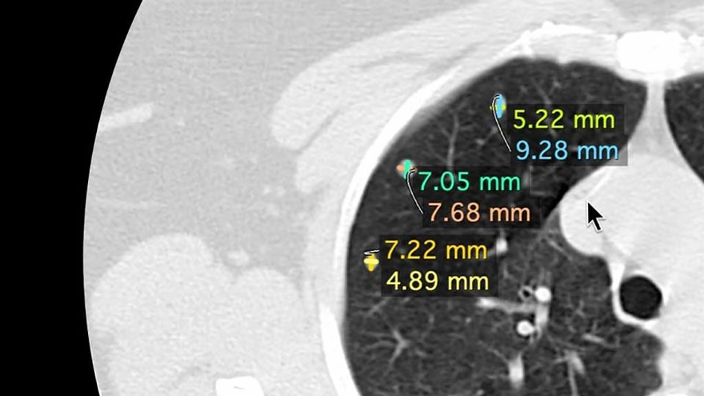 Imagen: NinesMeasures mide automáticamente los ejes de los nódulos pulmonares (Fotografía cortesía de Nines) Imagen: NinesMeasures mide automáticamente los ejes de los nódulos pulmonares (Fotografía cortesía de Nines)