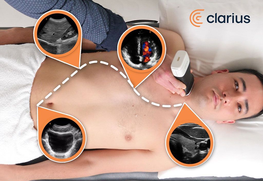 Imagen: Los escáneres de ultrasonido de alta definición de Clarius ahora permiten a los médicos examinar rápidamente el abdomen, el corazón, los pulmones, la vejiga y otras estructuras superficiales (Fotografía cortesía de Clarius Mobile Health) Imagen: Los escáneres de ultrasonido de alta definición de Clarius ahora permiten a los médicos examinar rápidamente el abdomen, el corazón, los pulmones, la vejiga y otras estructuras superficiales (Fotografía cortesía de Clarius Mobile Health)
