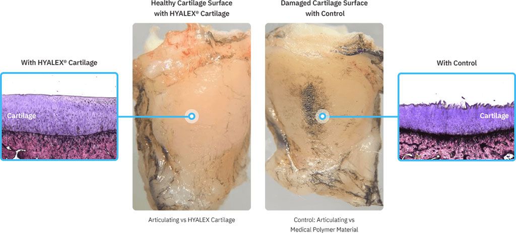 Imagen: Comparación del cartílago Hyalex con un polímero médico (Fotografía cortesía de Hyalex Orthopaedics)
