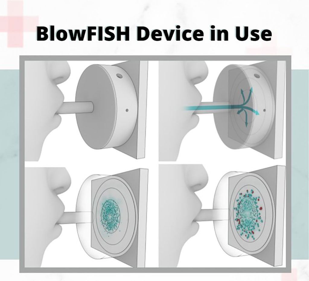 Imagen: Dispositivo novedoso BlowFISH que captura virus dentro del condensado de respiración exhalado (EBC) (Fotografía cortesía de Medivolve Inc.)