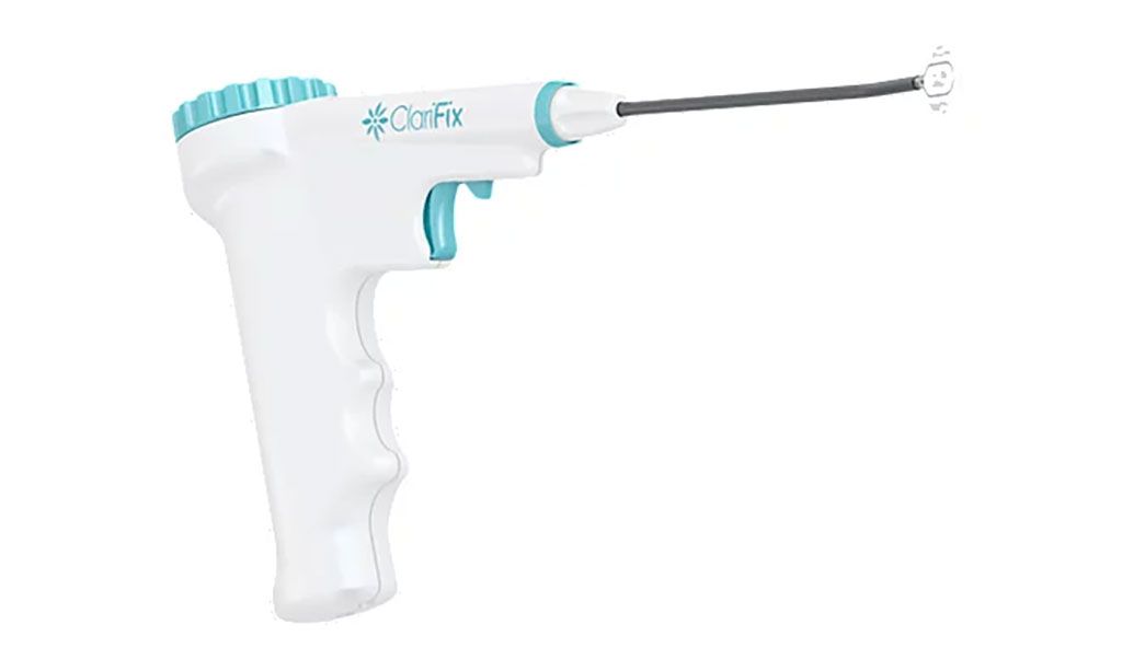 Imagen: El dispositivo de crioterapia ClariFix (Fotografía cortesía de Stryker)
