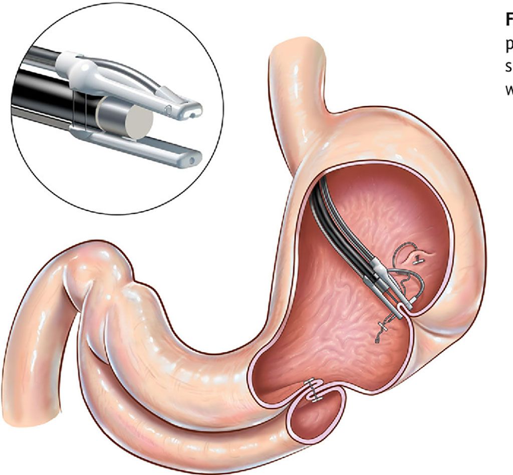 Imagen: Una nueva engrapadora GI funciona a través de la boca (Fotografía cortesía de ETT)