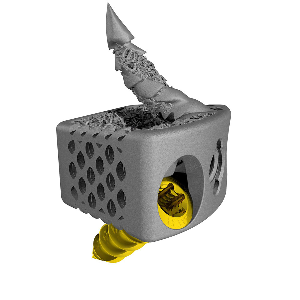 Imagen: CoreLink Fusation es parte del sistema de fusión cervical independiente F3D-C2 (Fotografía cortesía de CoreLink, LLC)