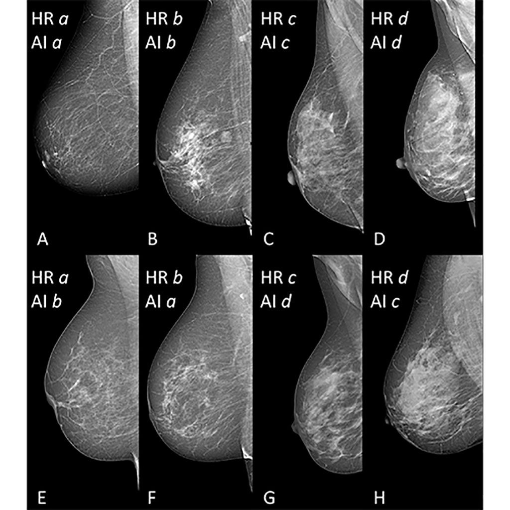 Imagen: Selección de vistas oblicuas mediolaterales mamográficas de senos con diferente densidad mamaria (Fotografía cortesía de RSNA) Imagen: Selección de vistas oblicuas mediolaterales mamográficas de senos con diferente densidad mamaria (Fotografía cortesía de RSNA)