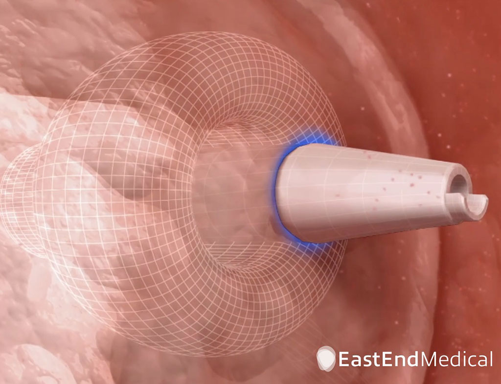 Imagen: Sistema SafeCross cruzando el tabique auricular usando el dilatador de punción RF (Fotografía cortesía de East End Medical)